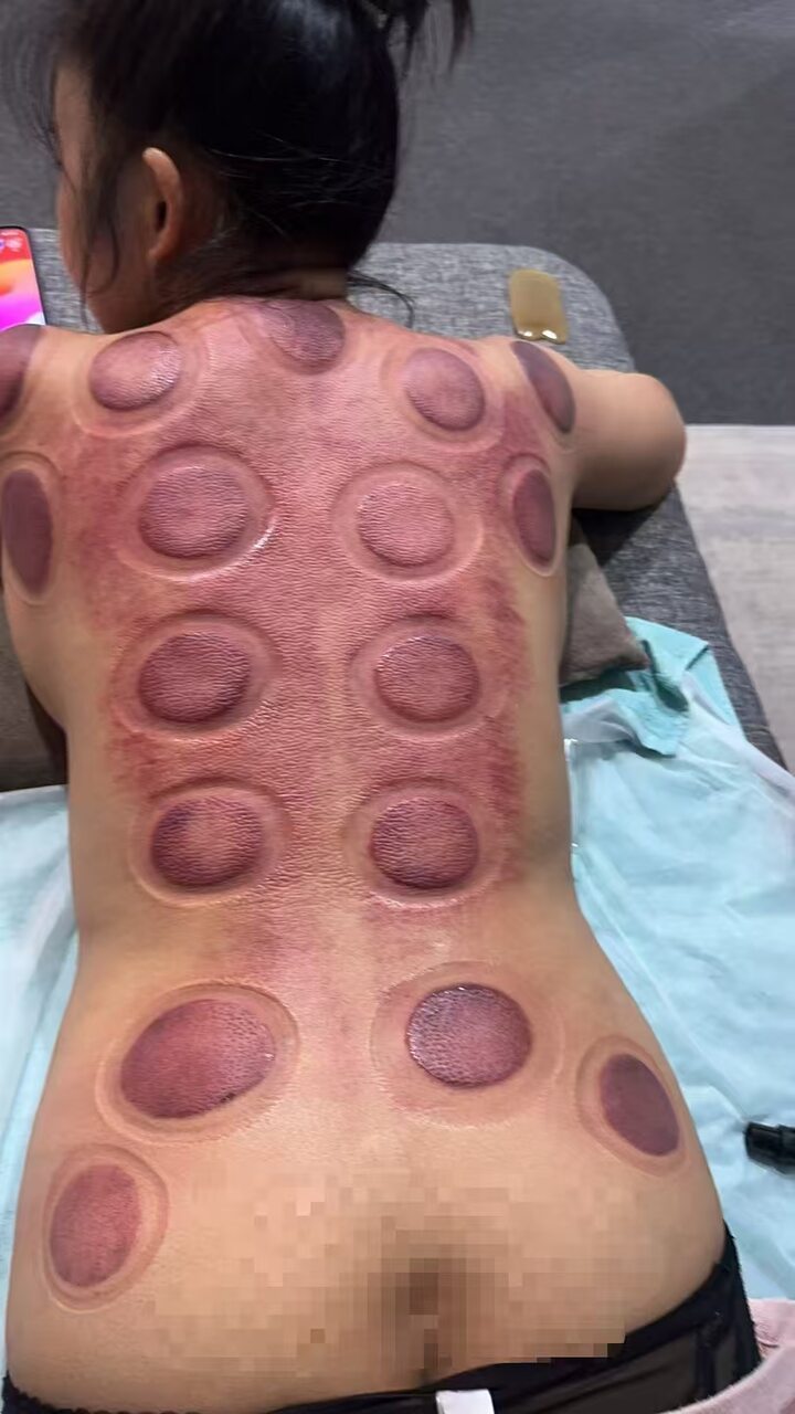 拔罐.jpg